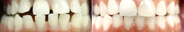 invisalign-before-after-3