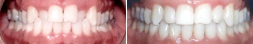 invisalign-before-after-nj-2